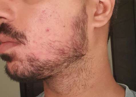 image comparison after